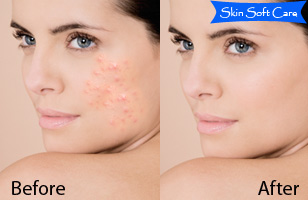 Rs. 99 to get skin treatment worth Rs. 500 at Skin Soft Care