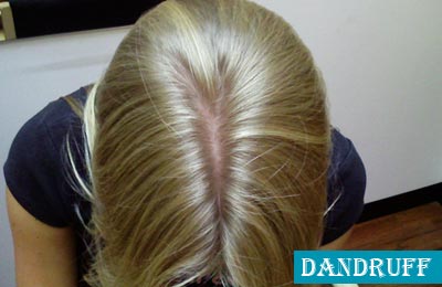 Rs. 75 for complete screening of scalp and hair root worth Rs. 500